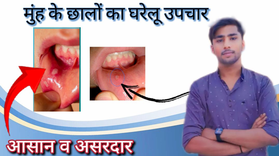 ⁣Muh ke chhale thik kare ll aayurvedik upchar ll #aayuvedic