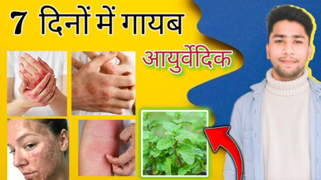 ⁣चर्म रोग के घरेलू उपाय l skin rog ka ilaj l skin disease treatment in ayurvedaskin problem #aayurved