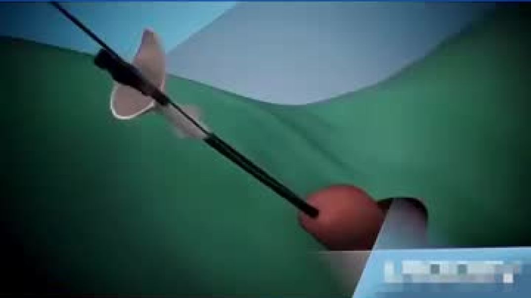 ⁣Kidney stones treatment _ Rirs Animation _ How kidney stones are removed _kidneystones(360P)