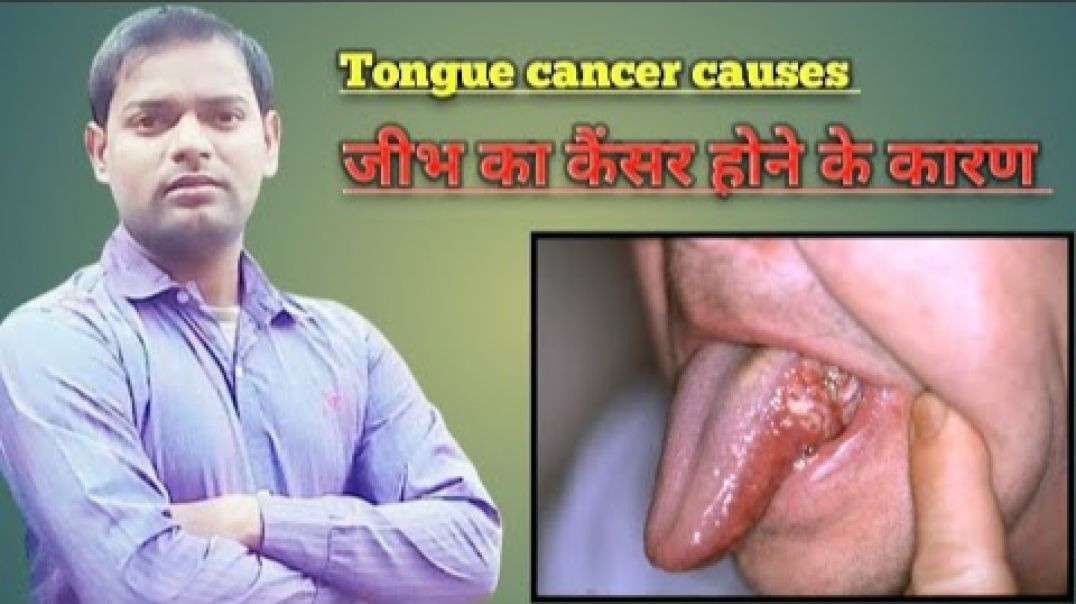 ⁣Tongue cancer causes । जीभ में कैंसर होने के कारण ।(720P_HD)