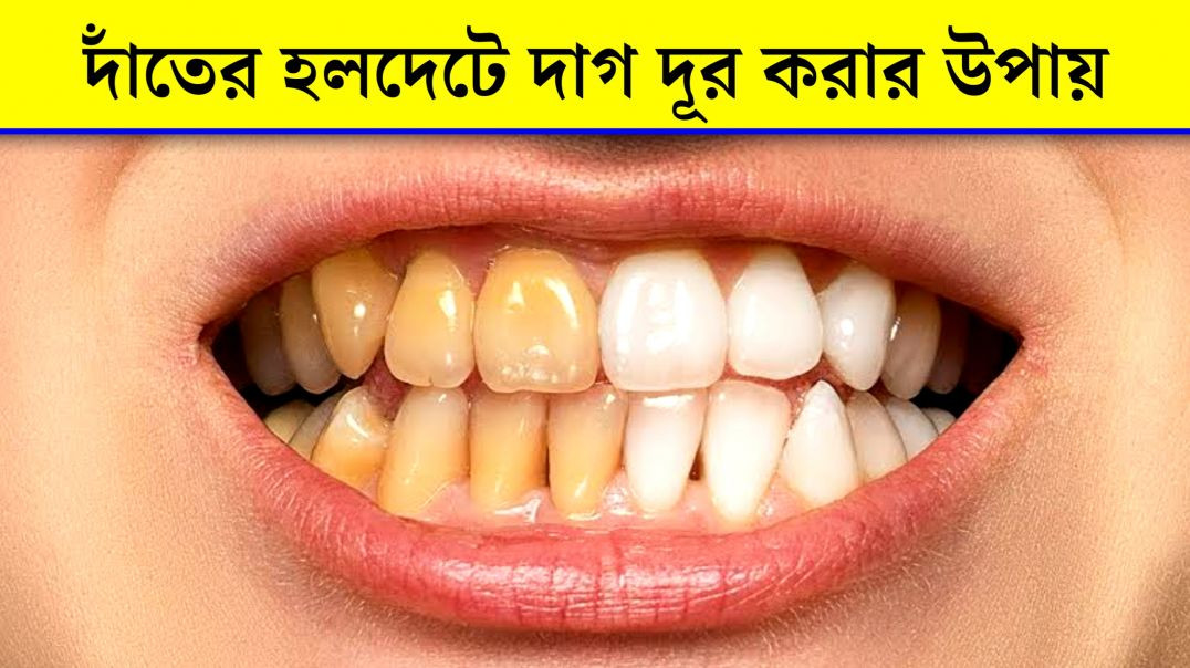 ⁣দাঁতের হলদেটেভাব দূর করার উপায় | Yellow Spot In Teeth