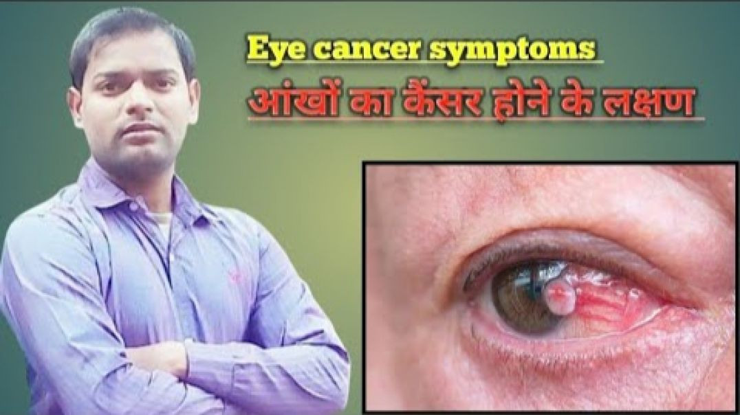 ⁣Eye cancer symptoms । आंखों का कैंसर होने के लक्षण ।(720P_HD)