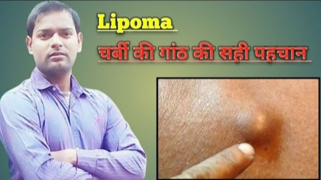 ⁣Lipoma । चर्बी की गांठ की सही पहचान और जांच ।(720P_HD)