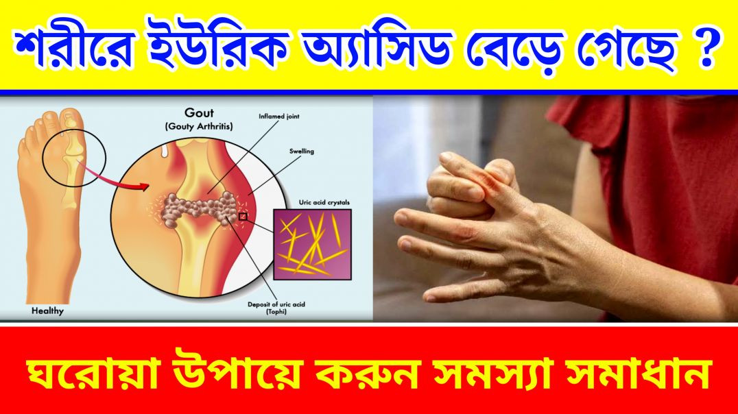⁣ইউরিক অ্যাসিডের জন্য গাঁটের ব্যথা | Uric Acid Problem