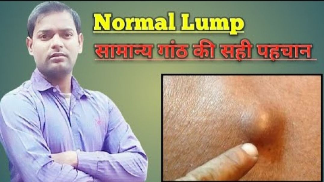 ⁣Normal Lump । सामान्य गांठ होने की सही पहचान और जांच ।(720P_HD)