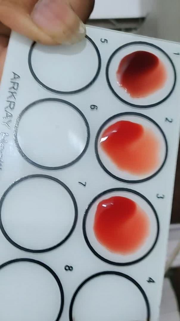 Blood group test 🎉🎉