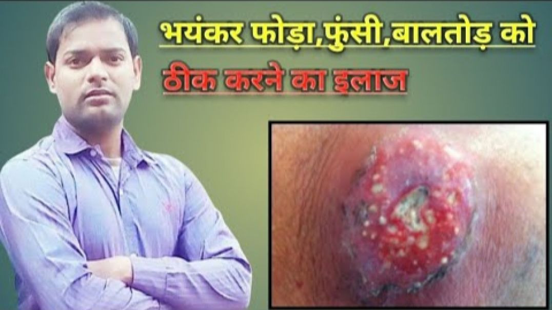 ⁣केवल 3 दिनों में भयंकर फोड़ा_फुंसी_बालतोड़ को ठीक करने का इ(720P_
