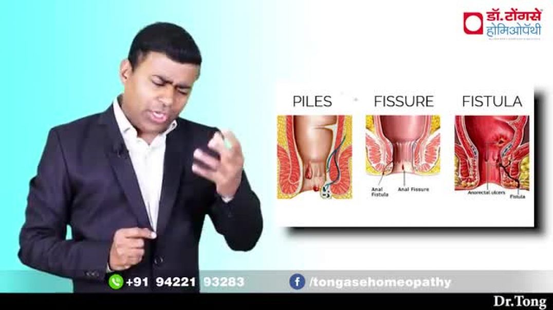 ⁣पाइल्स_फिशर_फीसतुला_में_क्या_है_फर्क_उलझन_करें_दूर_II_piles_fissure_fistula(360p)