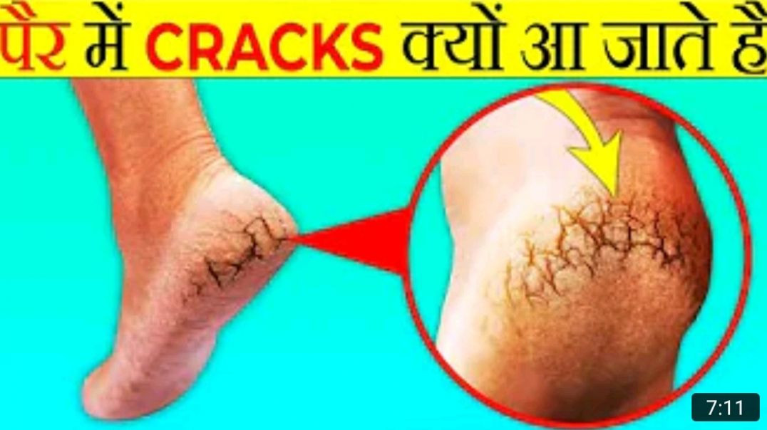 एड़ी_क्यों_फटने_लगती_है____Why_Do_These_Cracks_Come_In_The_Feet____Most_Amazing_Facts___FE_Ep_146_MP
